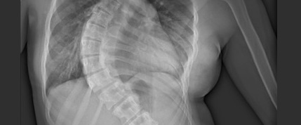 Immagine radiografica di una scoliosi (particolare)