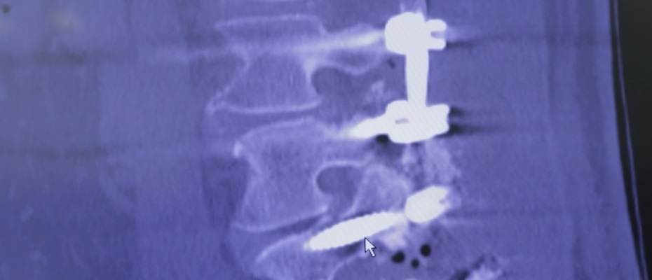 Immagine radiologica colonna vertebrale dal video