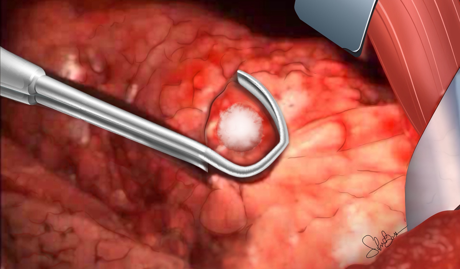 Figura 2: Resezione di metastasi polmonare mediante wedge resection eseguita con tecnica tradizionale (toracotomia)