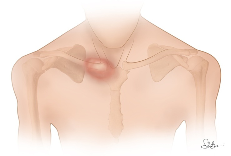 Fig. 2 - Gonfiore in sede sterno-clavicolare