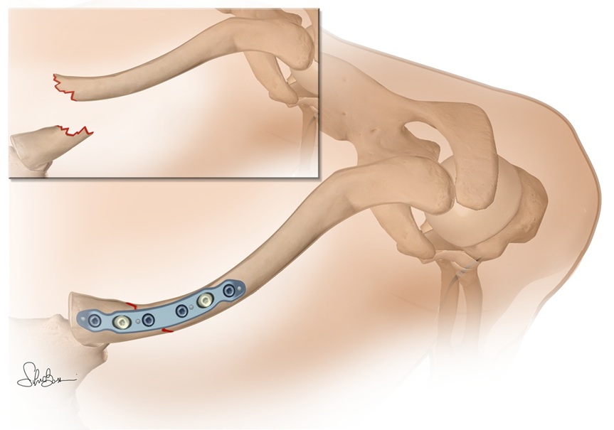 Fig. 3 - Frattura prossimale della clavicola – ricostruzione con placca
