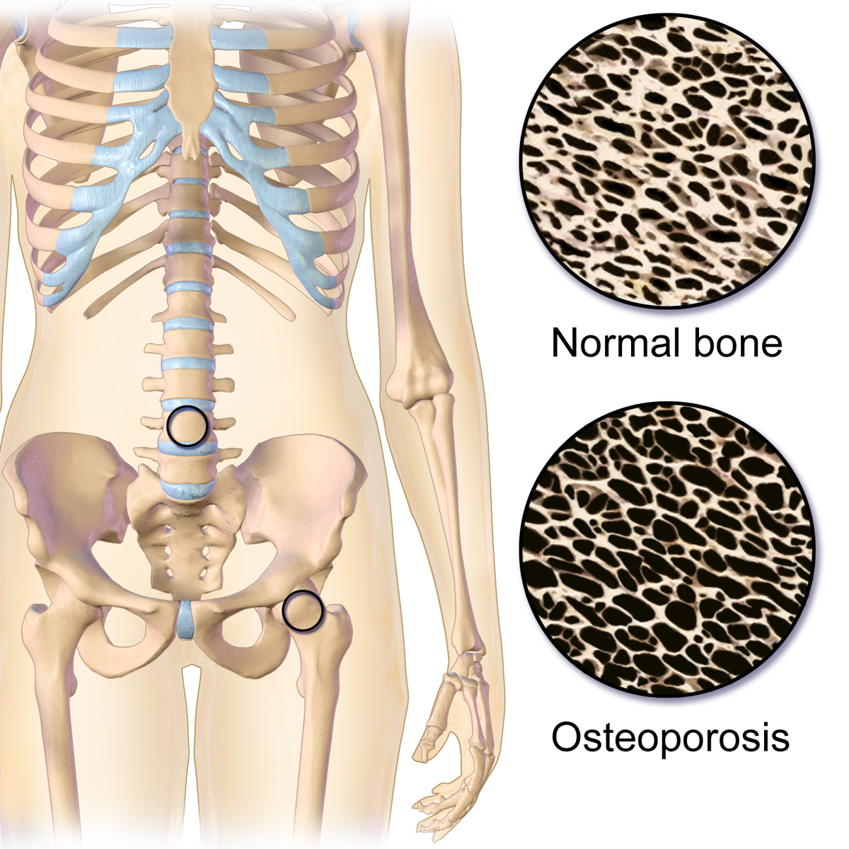 Immagine esempio di Osteoporosi