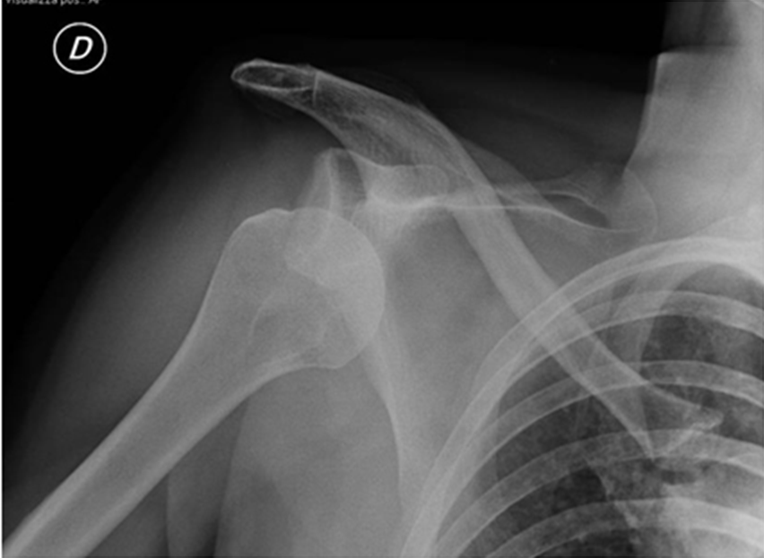 Fig. 1 - Esame radiografico di lussazione gleno-omerale anteroinferiore