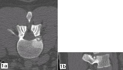 Figure 1a e 1b - La scansione TC sul piano trasversale (fig. 1a) e la ricostruzione su quello sagittale (fig. 1b) evidenziano la presenza di un piccolo osteoma osteoide del peduncolo Ds di L2 che aggetta nel forame di coniugazione.