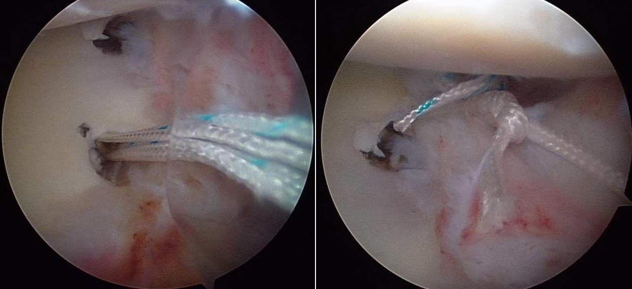 Arthroscopic capsuloplastic