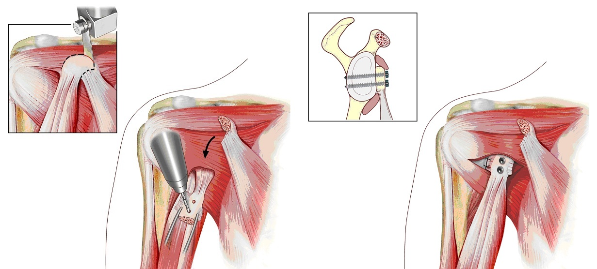 Latarjet capsuloplastic procedure