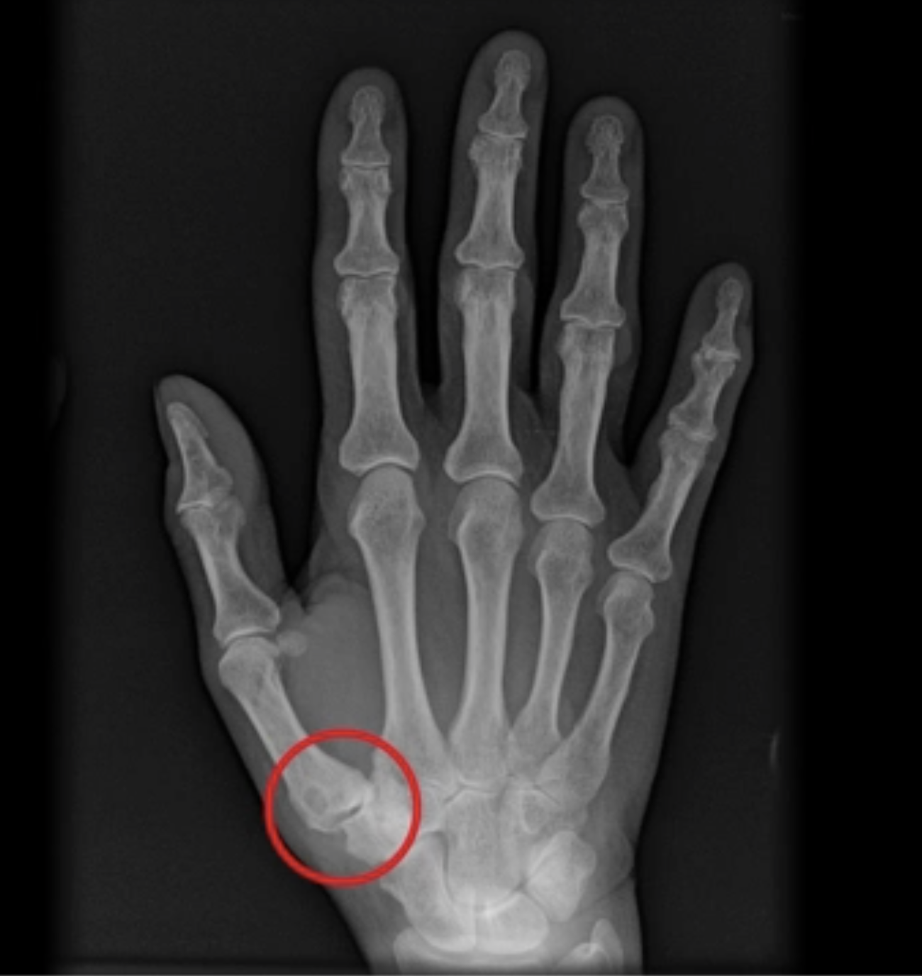 Figura 2 - Radiografia di mano affetta da rizoartrosi