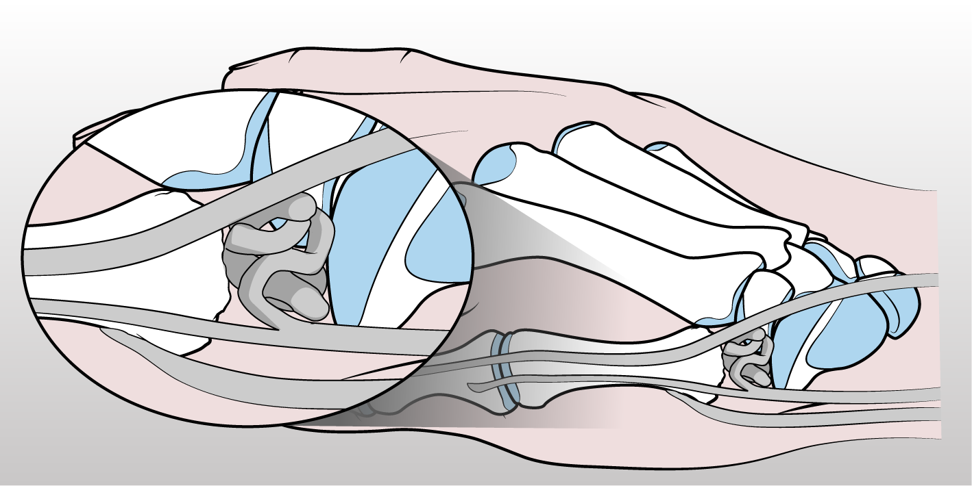 Figura 3 - Raffigurazione di trapezioctomia con artroplastica di sospensione