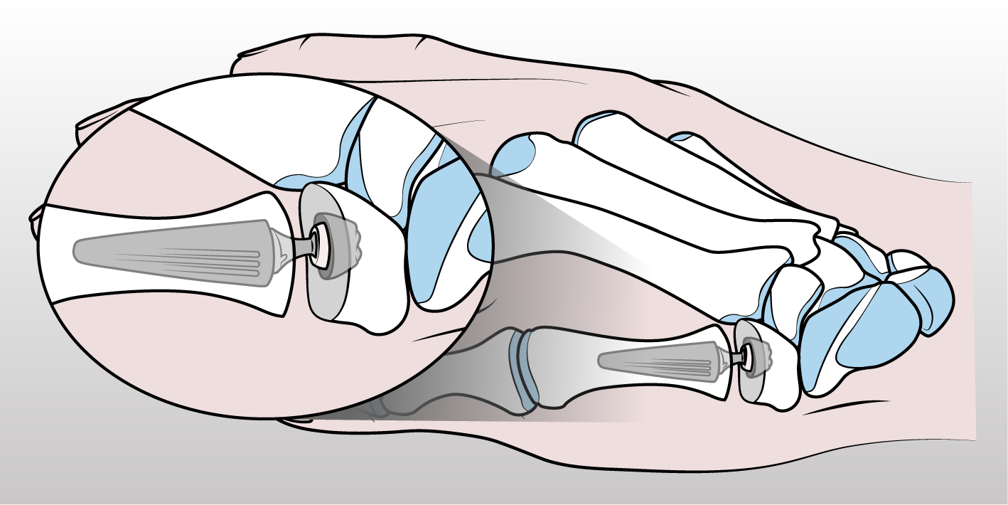 Figura 4 - Trattamento chirurgico di rizoartrosi con sostituzione protesica