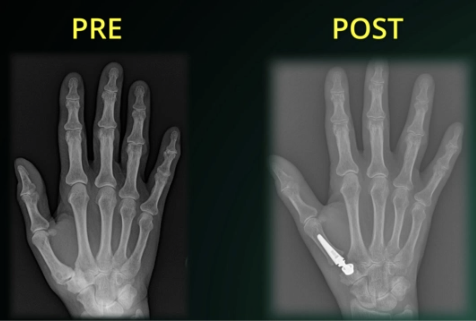 Figura 5 - Immagine radiografica pre e post intervento di sostituzione protesica