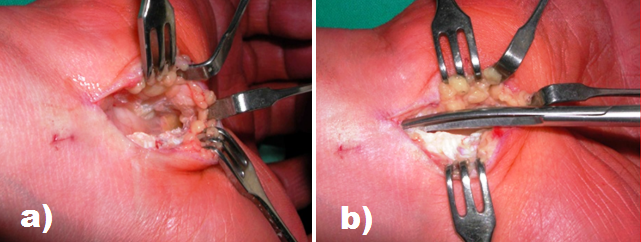 Fig. 3. a) Reperto chirurgico del nervo mediano che appare notevolmente schiacciato; b) liberazione del legamento trasverso del carpo.