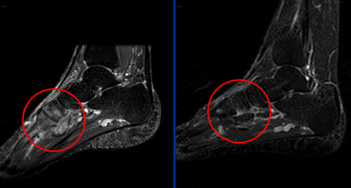 Risonanza Magnetica: miglioramento dell'edema osseo nella regione tarsale del piede dopo terapia con neridronato