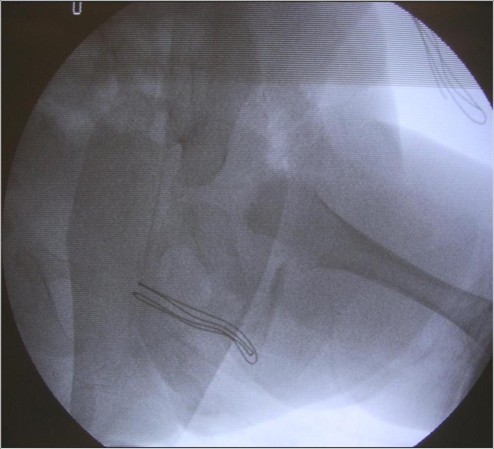 Fig.6c - Al controllo radiografico, riduzione dell'epifisi femorale nella cavità acetabolare