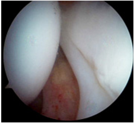Fig. 7: Sublussazione dell'epifisi femorale ottenuta mediante trazione (visione artroscopica)