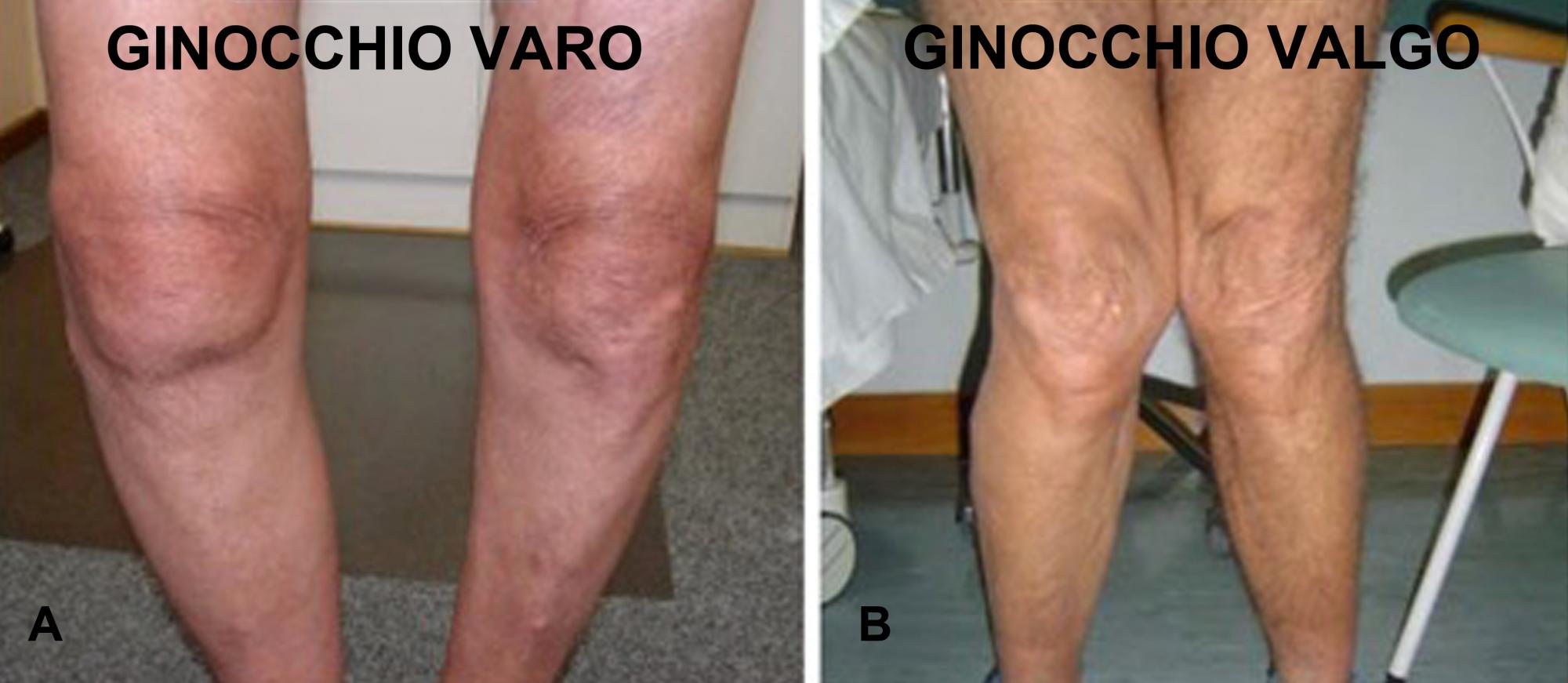 Fig. 3 - Deformità del ginocchio: A, ginocchio varo; B, ginocchio valgo