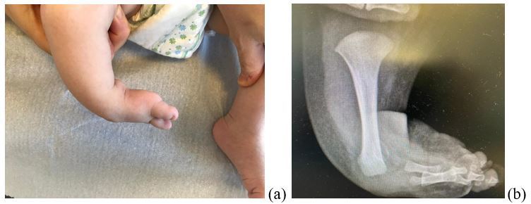 Fig.5: PTC secondario: l'assenza del perone, valutabile clinicamente (a) e radiograficamente (b), dimostra l'associazione tra il piede torto e un dismorfismo scheletrico