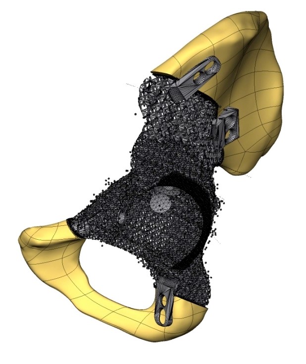 Le figg. 3, 4 e 5 mostrano la ricostruzione 3D virtuale del bacino, la progettazione delle guide di taglio e della protesi