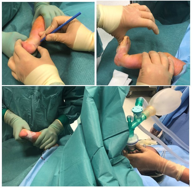 Fig. 7: PTC destro durante l'intervento chirurgico di tenotomia percutanea del tendine d'Achille: tramite un'incisione millimetrica viene eseguita la sazione completa del tendine d'Achille. Al suo temine, una manovra corretta permette di dorsiflettere completamente il piede. La procedura viene eseguita in sala operatoria con il supporto anestesiologico e non prevede l'utilizzo di punti di sutura
