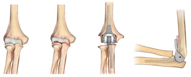 Fig.2 - a) gomito normale; b) gomito artrosico; c, d) impianto di protesi totale di gomito