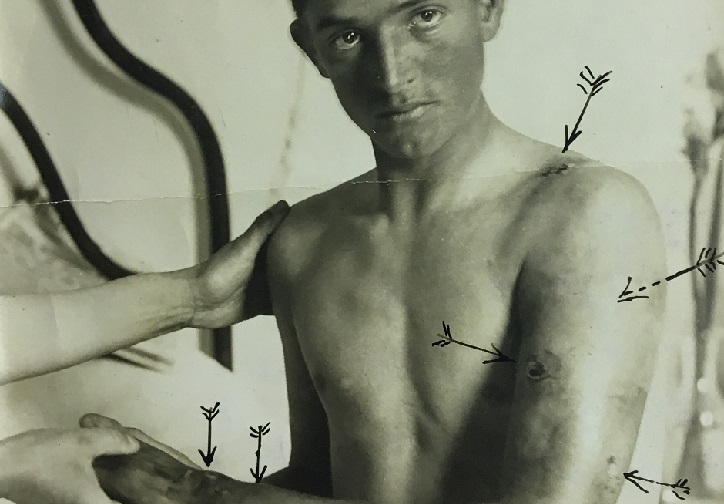  Photograph of a soldier hospitalized at the Rizzoli - Historical photographic archive of the Rizzoli Orthopaedic Institute