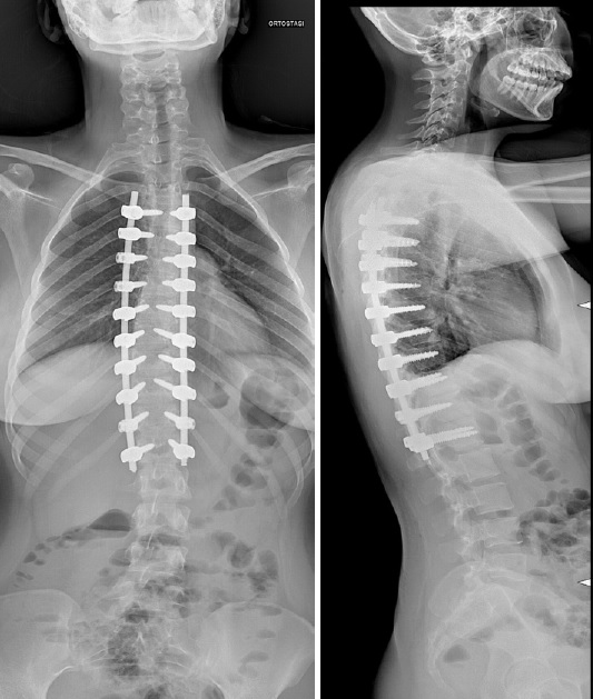 Immagine radiografica di artrodesi posteriore