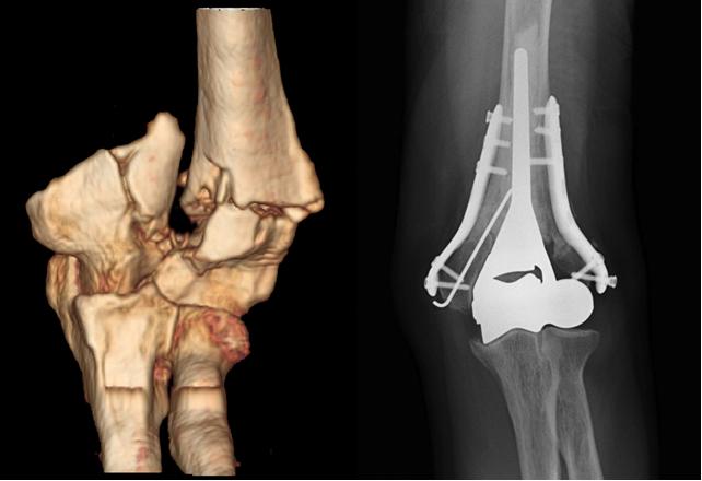 Fig. 8: La protesi metallica sostituisce la parte articolare fratturata in modo irricostruibile mentre le placche in titanio permettono la ricostruzione dei frammenti ossei intorno alla protesi (sede dei legamenti collaterali del gomito)